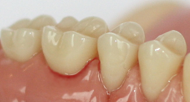 Foto: Zahnfleischbluten